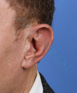 ear of a male patient with macrotia deformity