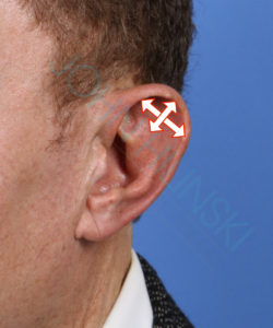 ear of a male patient with arrows indicating excess cartilage causing macrotia deformity