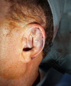 ear of a male patient immediately after macrotia ear reduction surgery performed by Dr. Hilinski