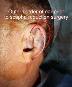 ear of a male patient immediately after macrotia ear reduction surgery with a red line showing outer border of the ear prior to scapha reduction 
