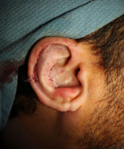ear of a male patient immediately after ear reduction surgery