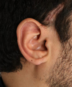 ear of a man with Conchal Bowl Hypertrophy