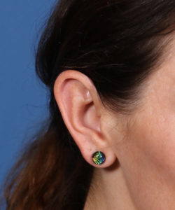 female patient with macrotic ears

