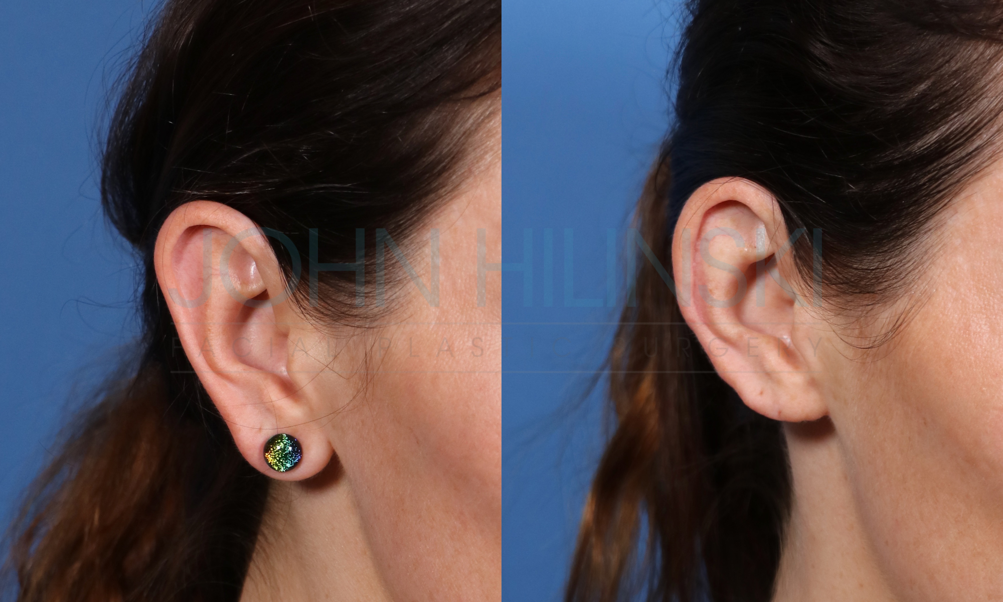 female patient's ear before and after macrotia ear reduction surgery performed by Dr. Hilinski
