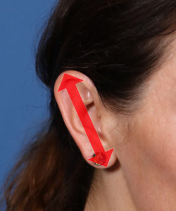 female patient's ear wit a red arrow indicating macrotia