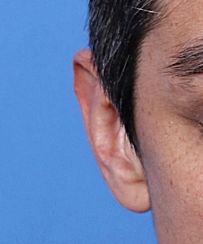 front view of an ear of a male patient with macrotic ears