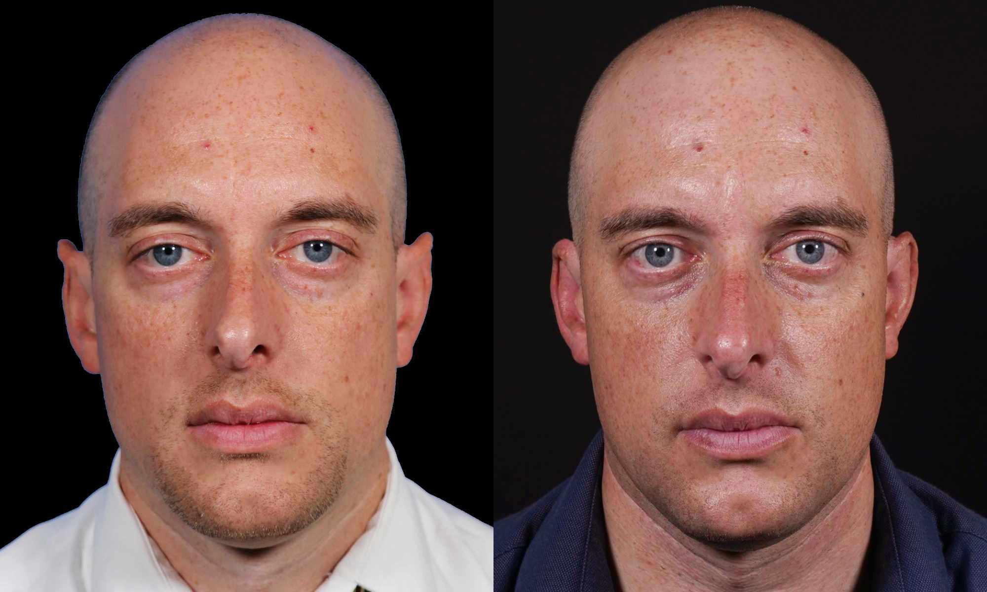 male patient before and after revision ear plastic surgery to correct elf ears 