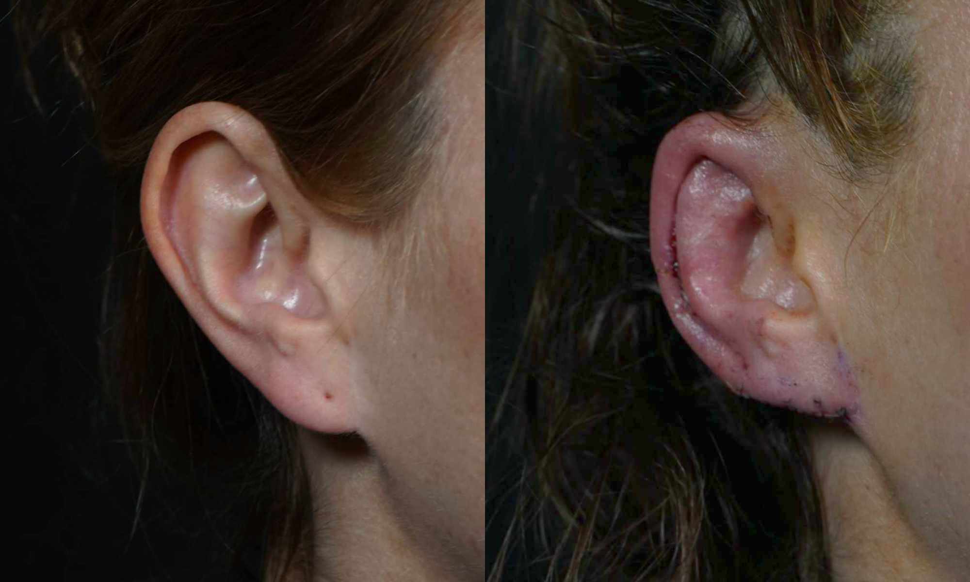 female patient's ear before and 48 hours after ear reduction plastic surgery performed by Dr. Hilinski
