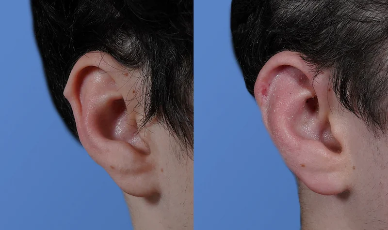 Before and After image of Darwin's Tubercle surgery