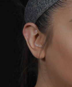 patient's ear before revision ear plastic surgery to correct macrotia