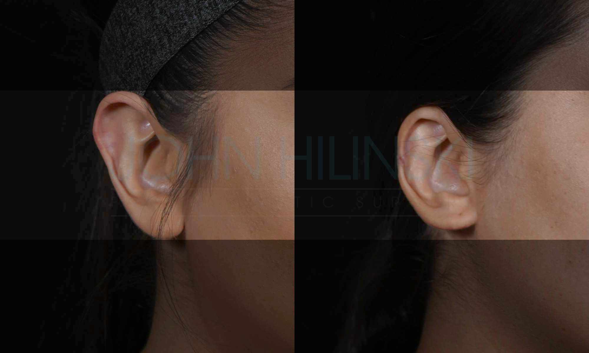 patient's ear before and after revision plastic surgery to correct macrotia after otoplasty 