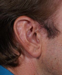 Male patient's ear before ear reduction surgery