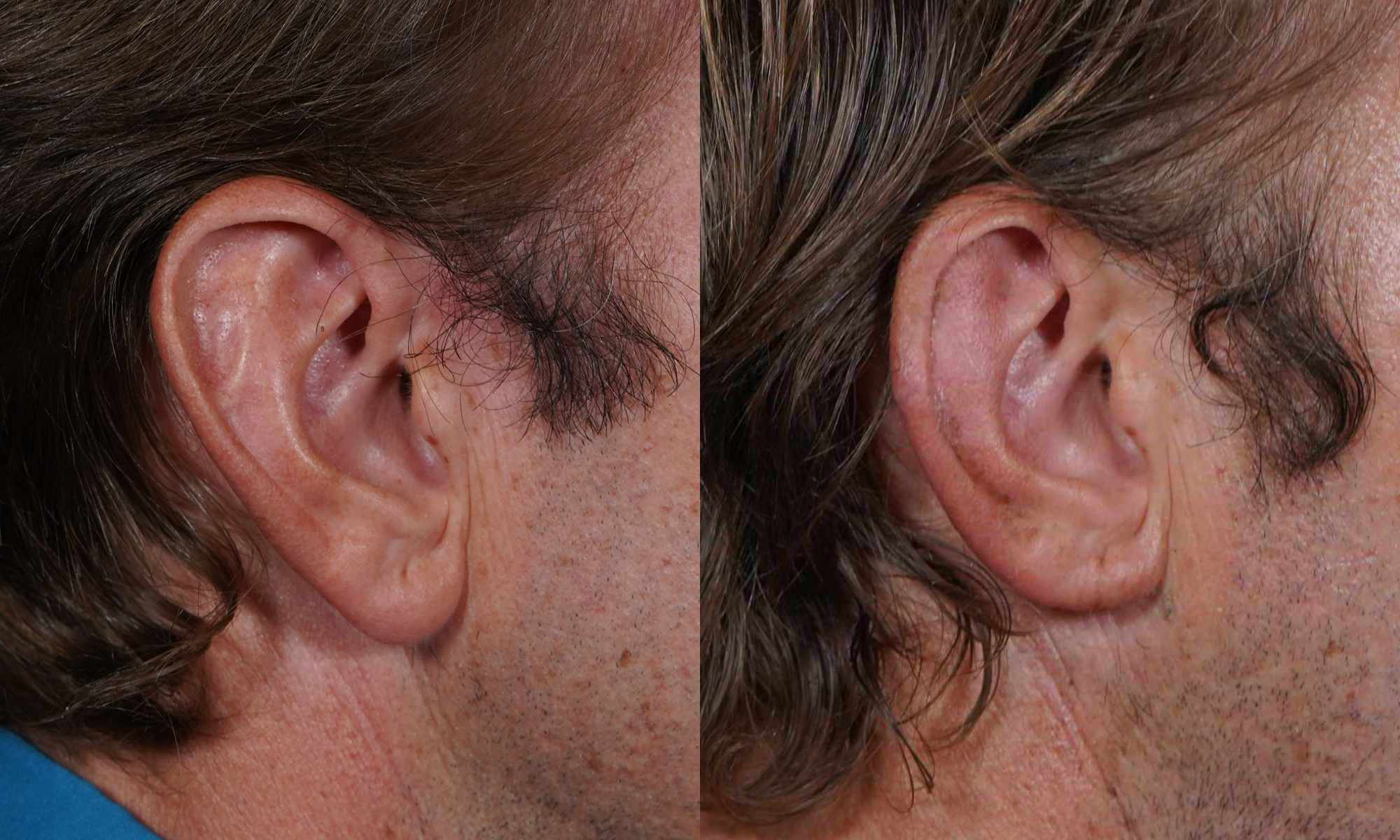 male patient's ear before and after ear reduction surgery by Dr. Hilinski