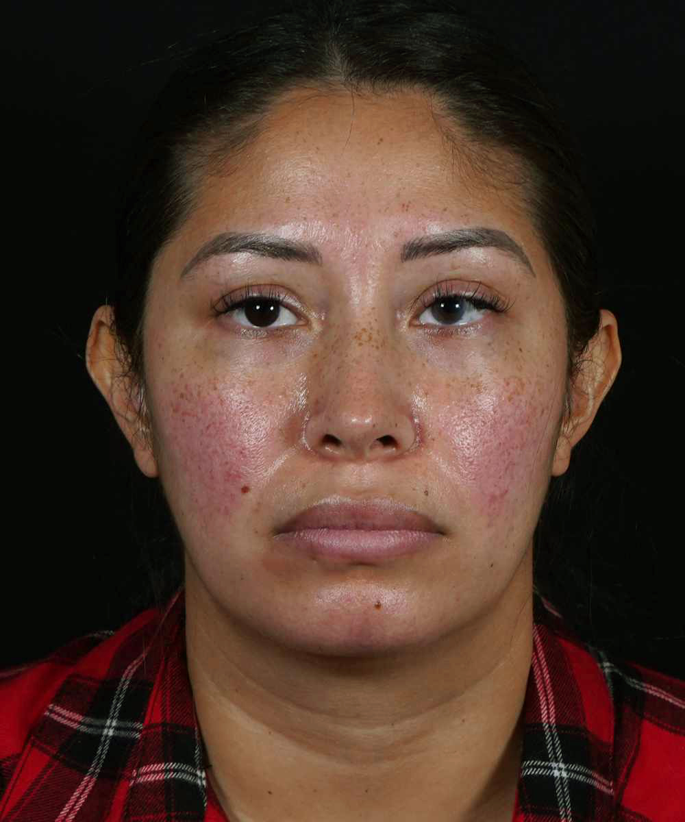 Dr. Hilinski's Macrotia surgery female patient before the procedure