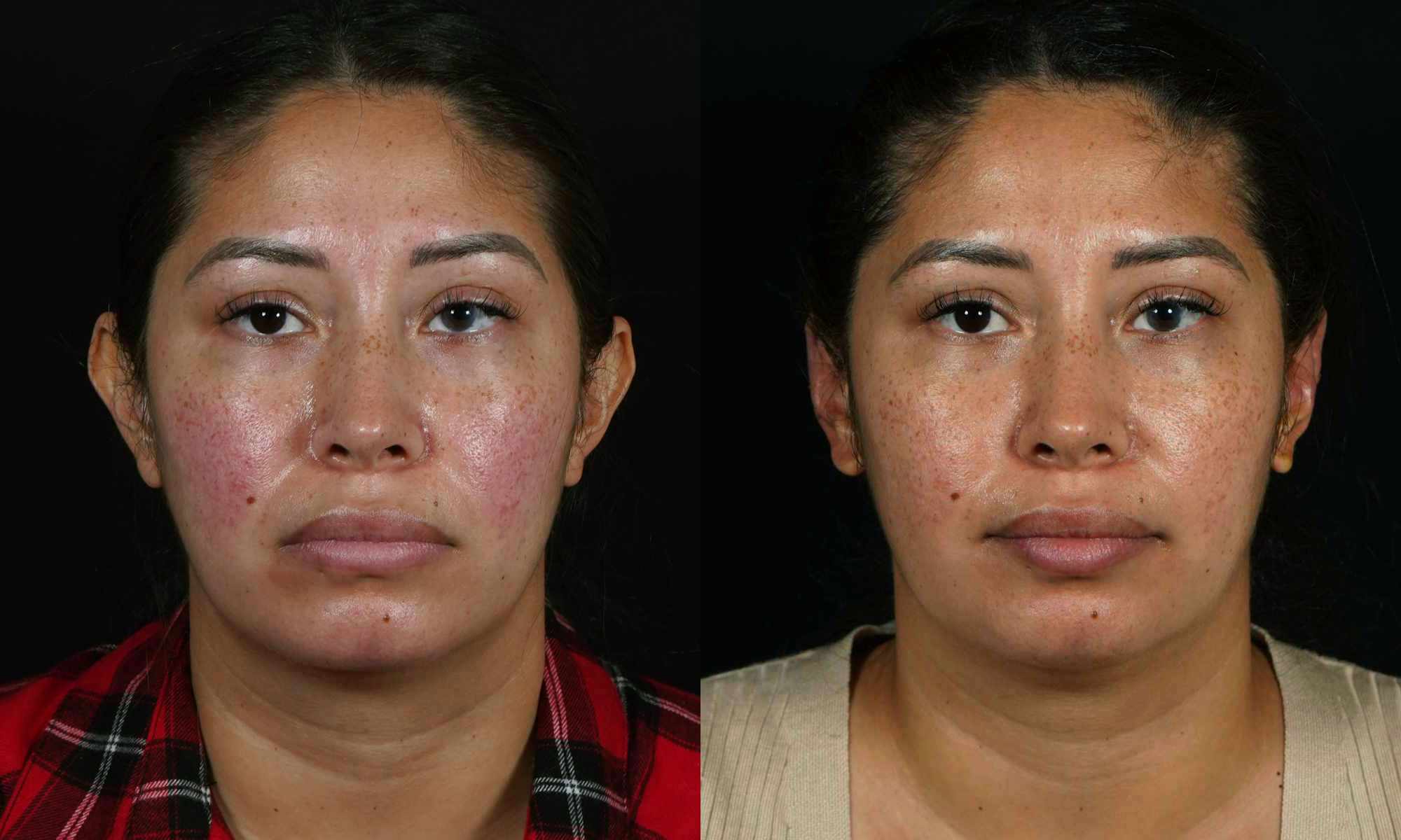 female patient before and after macrotia surgery  performed by Dr. Hilinski