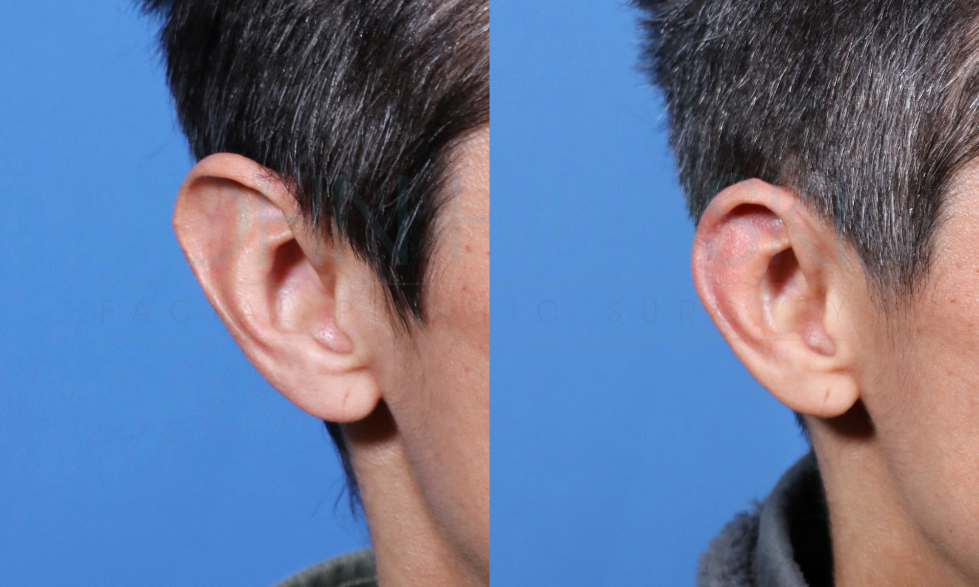 Macrotia oblique view ear reduction